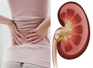 10 dấu hiệu bị bệnh sỏi thận dễ phát hiện nhất để ngăn chặn kịp thời